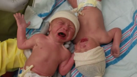 Megható: így sírtak születésük után az ikrek, amikor elválasztották őket - videó