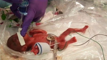 Életben maradt a 245 grammal született kislány