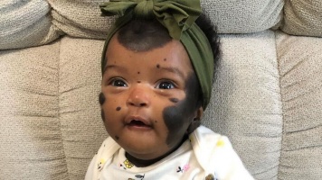 Nagyon különlegesen néz ki ez a boldog baba: egy ritka betegségtől sötét foltjai lettek