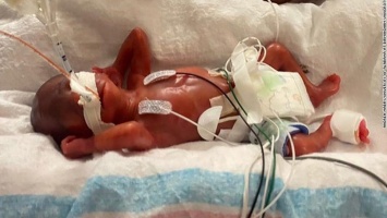Csodálatos! Ez a kisfiú 5 hónapra 420 grammal született, és életben maradt!